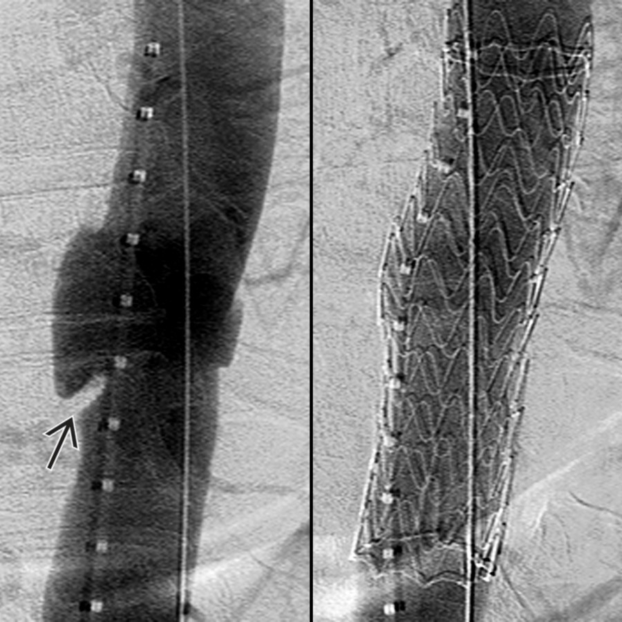 AP DSA performed intraoperatively (left) in the same patient shows the aortic injury , which was successfully treated with an endovascular stent graft (right).