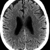 Axial NECT demonstrates mild sulcal enlargement & mild ventriculomegaly in a 70-year-old patient. The white matter appears completely normal, without periventricular hypodensities or white matter lacunar infarcts.