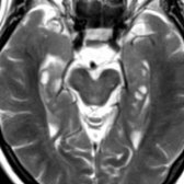 Axial T2 MR shows multiple CSF-like cysts in both hippocampi   just medial to the temporal horns of the lateral ventricles.