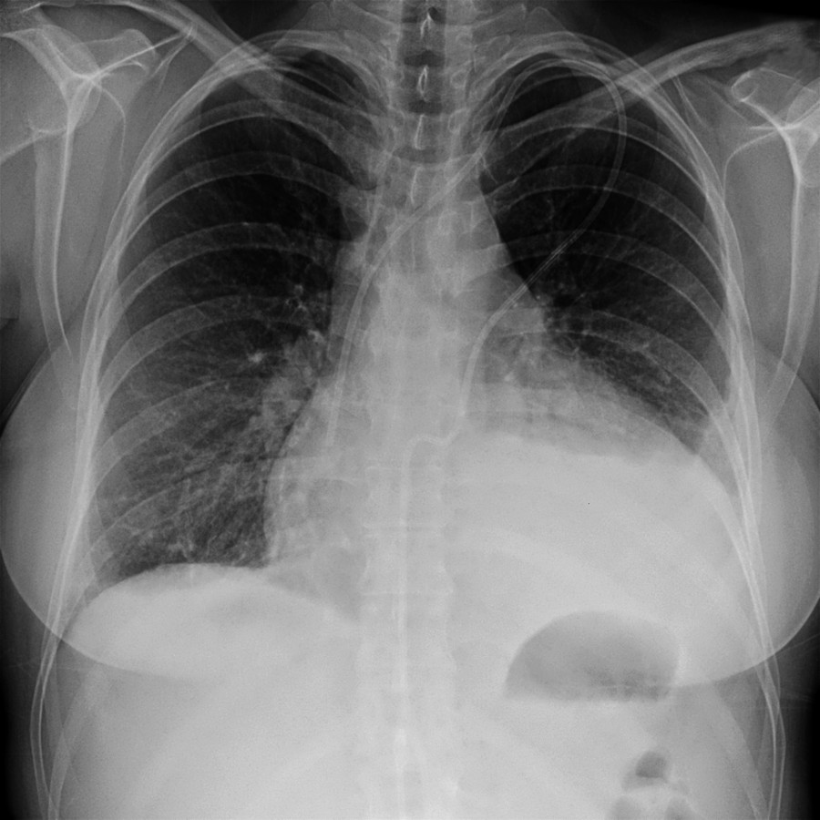 Frontal radiograph shows marked enlargement of the cardiac silhouette. The patient presented with increasing shortness of breath. Large pericardial effusion was found with presumed etiology of heart failure exacerbation.