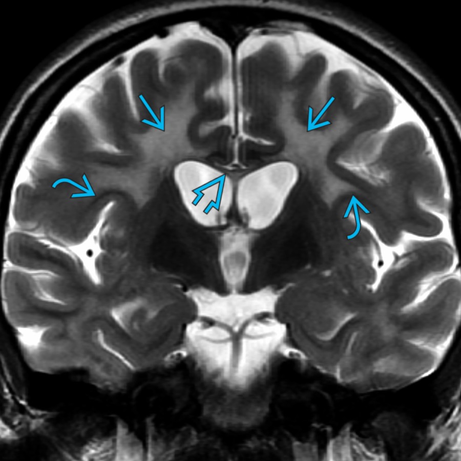Coronal T2 MR in a 13-year-old female patient with metachromatic leukodystrophy shows symmetric extensive WM signal abnormality  with preservation of the subcortical WM . Note the marked thinning of the CC .