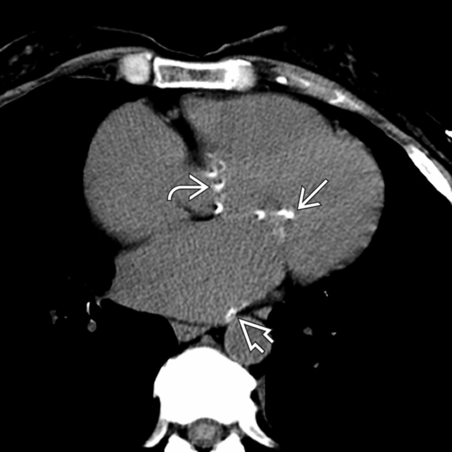 Axial NECT shows mitral valve leaflet calcifications in a patient with mitral stenosis  presumed to be due to rheumatic heart disease. Note the enlarged left atrium and left atrial calcifications . The patient also has aortic stenosis and calcifications .
