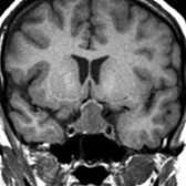 Coronal T1 MR in a 19-year-old pregnant woman who developed onset of vision problems in the late 3rd trimester shows a large "figure of 8," intra- and suprasellar mass  that elevates the optic chiasm .