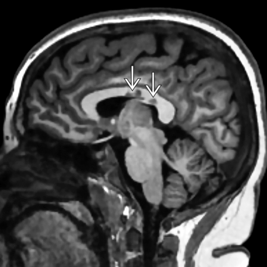 Sagittal T1 MR in a 14-year-old presenting with gait instability and facial numbness demonstrates T1-hypointense corpus callosum lesions   that represent "black holes" of chronic demyelination. This was the initial clinical MS presentation for this patient.