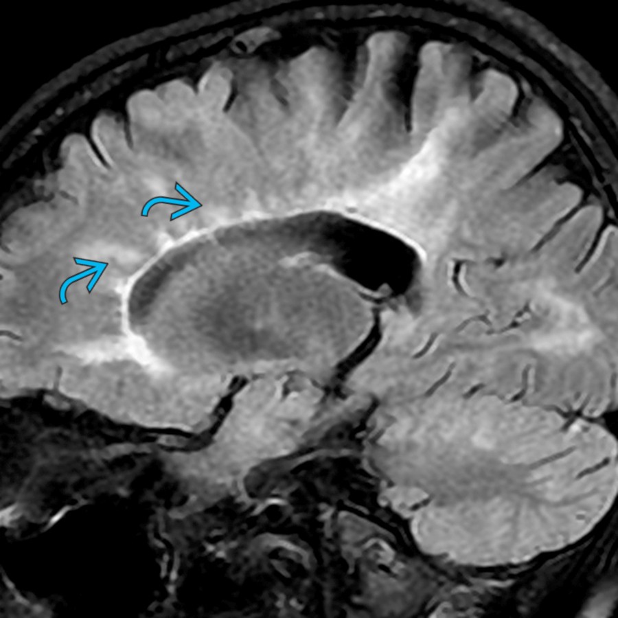 Sagittal FLAIR demonstrates numerous well-defined and ill-defined callososeptal hyperintensities  radiating from the lateral ventricular margin with a typical perpendicular orientation, characteristic of MS.