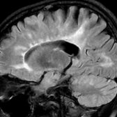 Sagittal FLAIR demonstrates numerous well-defined and ill-defined callososeptal hyperintensities  radiating from the lateral ventricular margin with a typical perpendicular orientation, characteristic of MS.