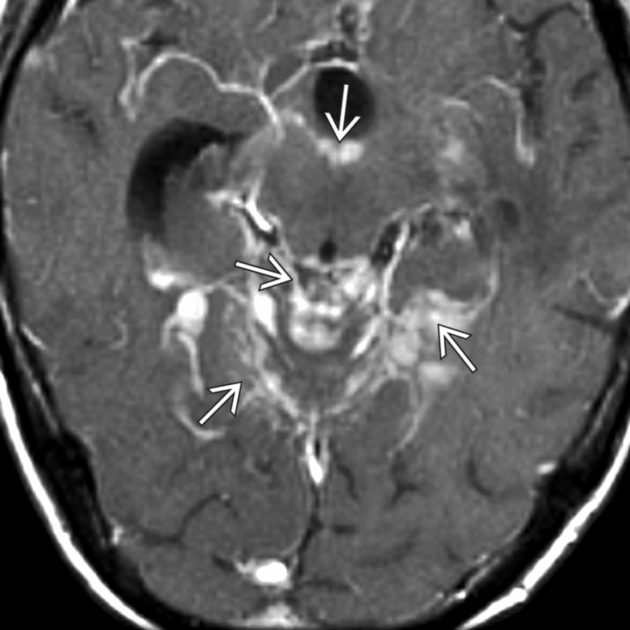 Axial T1 C+ MR demonstrates typical leptomeningeal (pia and arachnoid) metastases  involving quadrigeminal cistern as well as other structures via subarachnoid spread.