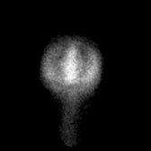 Anterior radionuclide cisternography at 24 hours demonstrates photopenia in the region of the lateral ventricles , a normal finding. This pattern of tracer distribution with activity only along the convexities is consistent with the type II CSF movement pattern (normal).