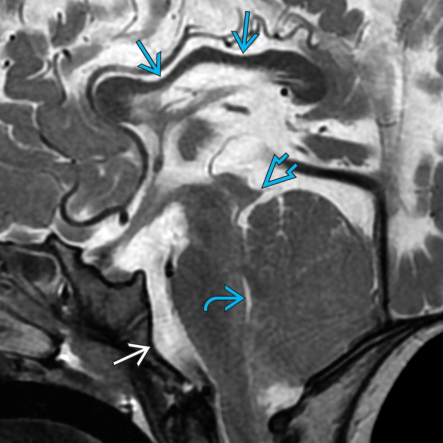 Midline sagittal T2 MR in a child with a repaired myelomeningocele & Chiari 2 malformation (with beaked tectum , small 4th ventricle , & scalloped clivus ) shows a thinned & dysmorphic CC .