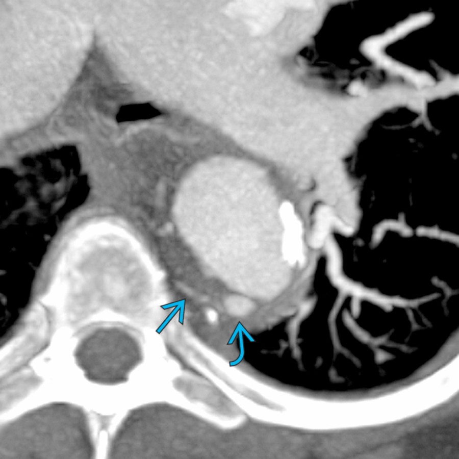 Axial MIP CTA in a patient with type B IMH shows an intramural blood pool (IBP) . There is no clear communication with the aortic lumen, but there is visible communication with an adjacent intercostal artery  .