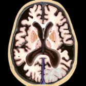 Axial graphic of vascular dementia (VaD) shows diffuse cerebral atrophy, focal volume loss due to multiple chronic infarcts , an acute left occipital lobe infarct , and small lacunar infarcts in the basal ganglia/thalami .