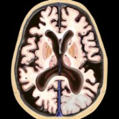 Axial graphic of vascular dementia (VaD) shows diffuse cerebral atrophy, focal volume loss due to multiple chronic infarcts , an acute left occipital lobe infarct , and small lacunar infarcts in the basal ganglia/thalami .