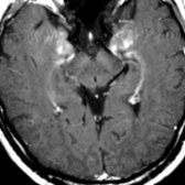 Axial T1 C+ MR in the same patient shows patchy enhancement  of the medial temporal lobes. LE is the only paraneoplastic syndrome with defined imaging features.