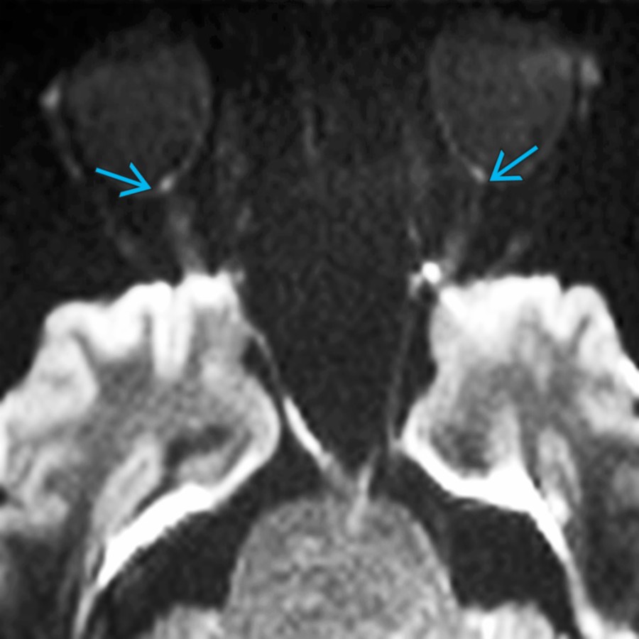 Axial DWI in the same patient demonstrates subtle high signal  in the region of the optic nerve heads bilaterally. Hyperintensity of the optic nerve heads on DWI can serve as a useful imaging marker for papilledema, especially if bilateral.