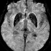 Axial T2* SWI MR demonstrates marked hypointensity in the basal ganglia  related to normal mineralization with age.