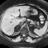 Axial T1 FS MR in the same patient confirms that the right adrenal lesion    is composed of fat, a finding pathognomonic of a myelolipoma. Signal suppression with fat saturation and persistent signal on out-of-phase imaging indicate macroscopic fat, rather than the intracellular lipid characteristic of adrenal adenomas.