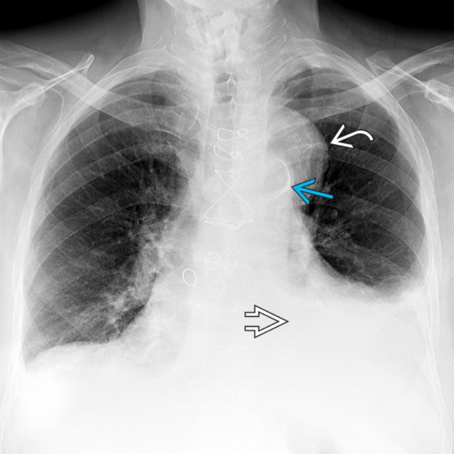 PA chest radiograph in a patient with penetrating aortic ulcer (PAU) of the aortic arch shows a mediastinal mass  lateral to the aortic arch from associated hematoma and a left pleural effusion . Note the aortic intimal calcification .