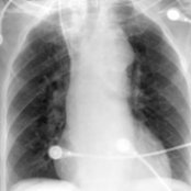 PA chest radiograph shows dilation of the thoracic aorta, evidenced by abnormal contour of the aortic arch  and displacement of the intrathoracic trachea to the right . The ascending aorta  is visible overlying the right hilum.