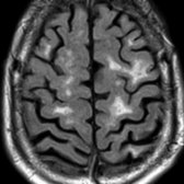 Axial FLAIR MR shows multiple subcortical hyperintensities  in a 76-year-old normotensive man with clinical diagnosis of vascular dementia. No focal infarcts are seen.