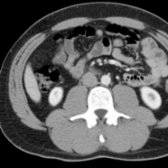 Axial correlative CECT at the level of the inferior pole of the right kidney is shown. The psoas muscle and quadratus lumborum muscles, seen in their midsections, are now thicker.
