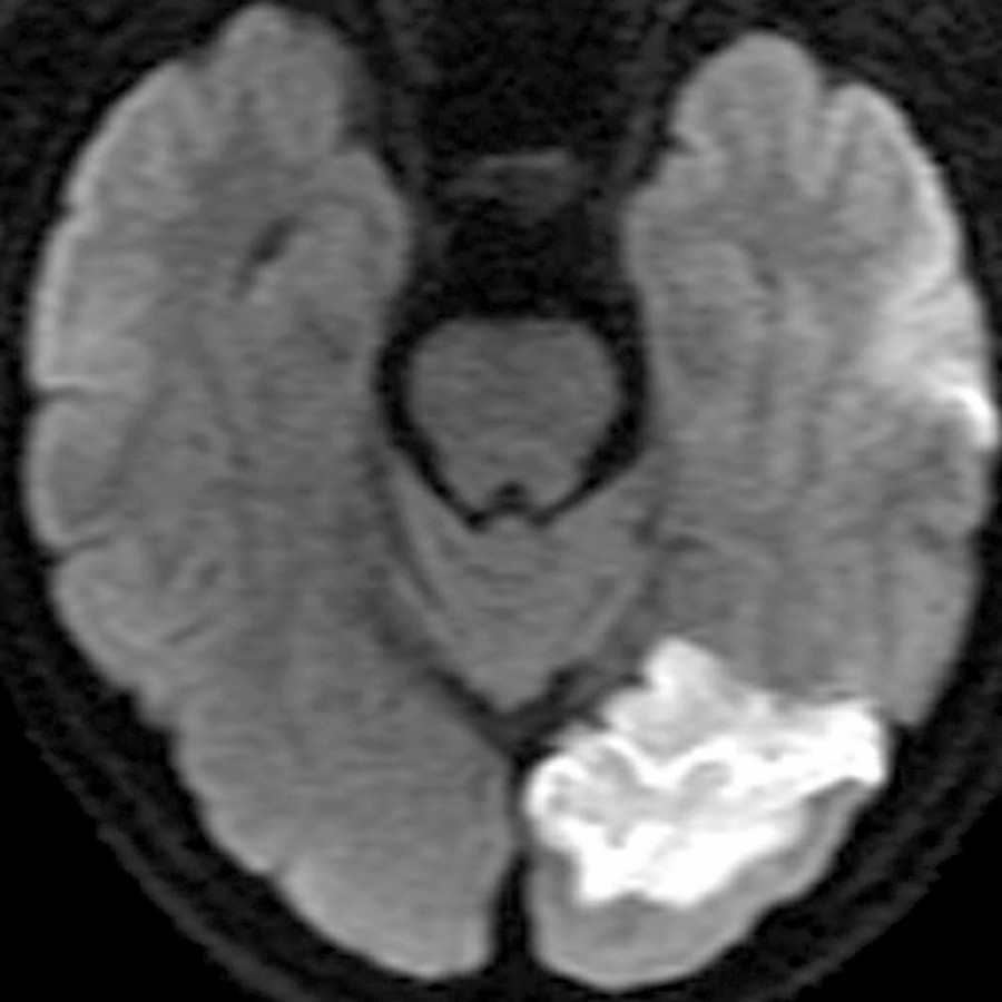 Axial DWI trace MR in a 61-year-old patient 3 days after symptoms shows DWI restriction. True restricted diffusion persists several days after stroke onset and gradually reverses with DWI hypointensity and ADC hyperintensity.