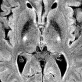 Axial FLAIR MR in the same patient shows hyperintense signal in the posterior limbs of bilateral internal capsule along the CSTs .