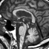 Sagittal T1WI MR in a patient with progressive supranuclear palsy shows markedly diminished size of midbrain relative to pons. The cephalad surface of the midbrain appears concave , in contrast to the normal convex superior profile.
