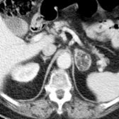 Axial CECT shows a predominantly fatty left adrenal mass.