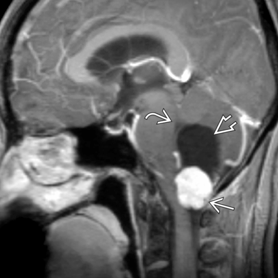 Sagittal T1WI C+ MR shows an enhancing vermian mass protruding through the foramen magnum . An associated cyst  is deforming the 4th ventricle .