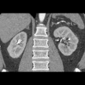 First of 2 coronal CECT images shows the adrenal glands in their suprarenal location, which accounts for their alternate name of "suprarenal glands."