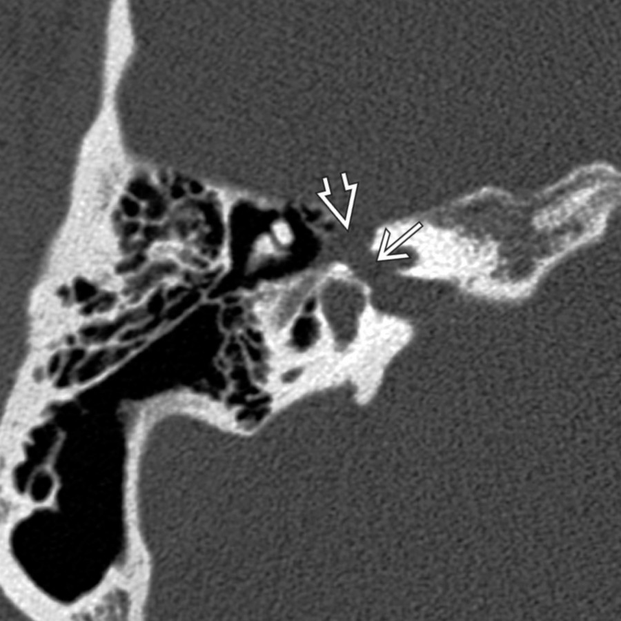 Axial bone CT reveals smooth scalloped enlargement of the labyrinthine segment of the facial nerve canal  and geniculate fossa  in a patient with facial nerve schwannoma of CPA-IAC. Notice there is erosion into subjacent cochlea.