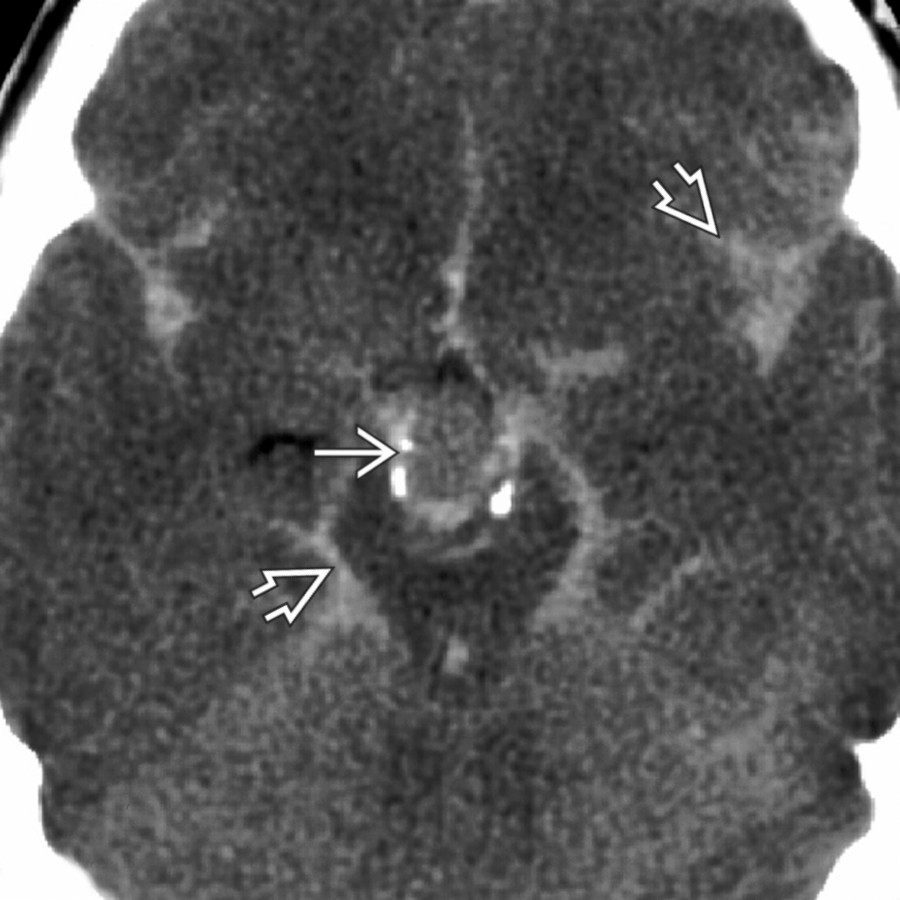 Axial NECT shows a subarachnoid hemorrhage  from a partially thrombosed, calcified  basilar tip aneurysm.
