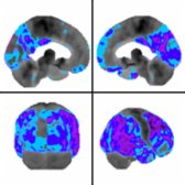 Surface images with quantitative mapping show decreased activity in the posterior cingulate gyrus, precuneus and temporal lobes (blue/purple) with sensorimotor sparing , concerning for Alzheimer disease (AD) copathology. DaT scan was not performed.