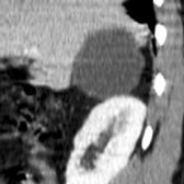 Sagittal reformation of CECT shows a nonenhancing right adrenal cyst .