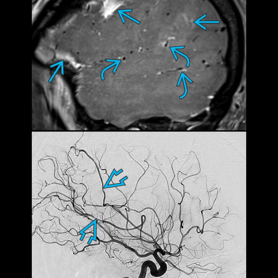 T1 SPACE C+ vessel wall MR (VW-MR) in a patient with SAH  shows concentric enhancement in multiple MCA branches . DSA after a few days shows mutifocal MCA branch stenoses . Consider early preventive measures initiation to reduce vasospasm later, if VW-MR done during presentation with SAH shows arterial wall enhancement.