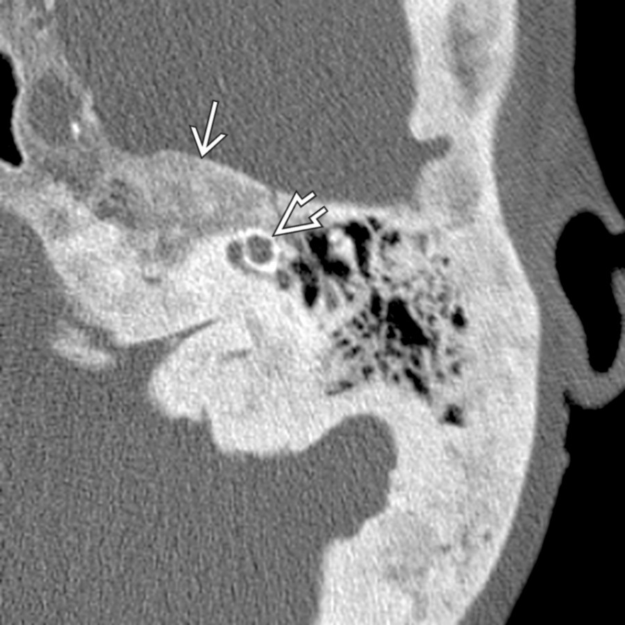 Axial bone CT shows late-phase Paget disease with diffuse bony expansion with areas of demineralization . Notice that the bony labyrinth along the anterior cochlear surface is involved .
