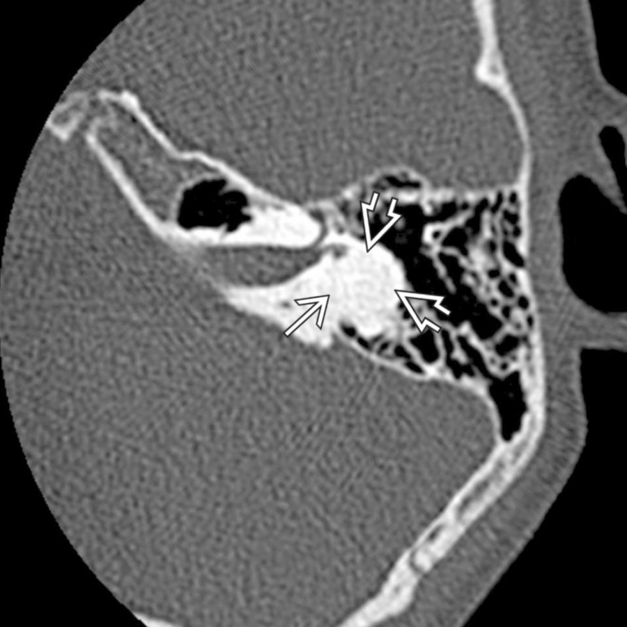 Axial bone CT in a patient with prior history of meningitis shows complete ossification of the vestibule  and lateral semicircular canal . There was also partial opacification of the cochlea (not shown).