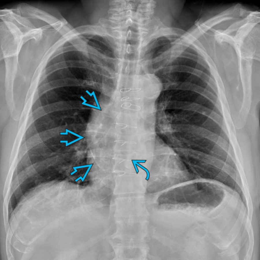 PA radiograph in a 73-year-old man with a history of bicuspid valve status post repair  shows abnormal right-sided convexity along the superior cardiomediastinal silhouette , suggestive of an ascending aortic (AA) aneurysm. In this case, atherosclerotic calcifications allow for partial visualization of the AA.