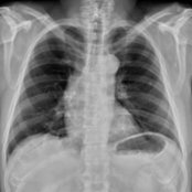 PA radiograph in a 73-year-old man with a history of bicuspid valve status post repair  shows abnormal right-sided convexity along the superior cardiomediastinal silhouette , suggestive of an ascending aortic (AA) aneurysm. In this case, atherosclerotic calcifications allow for partial visualization of the AA.