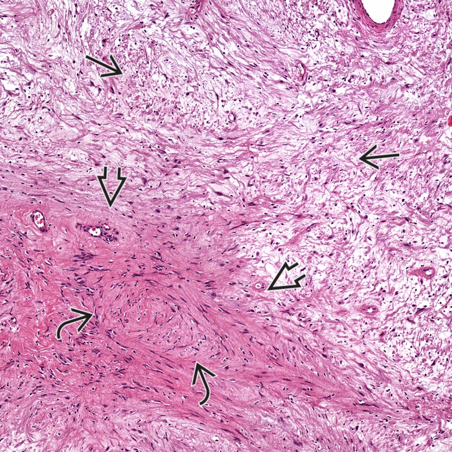 Low-powered H&N micrograph shows the hypocellular appearance of spindled cells associated with a myxoid and edematous Antoni B area , adjacent to an Antoni A  cellular area that is more hypercellular with a whorled pattern .