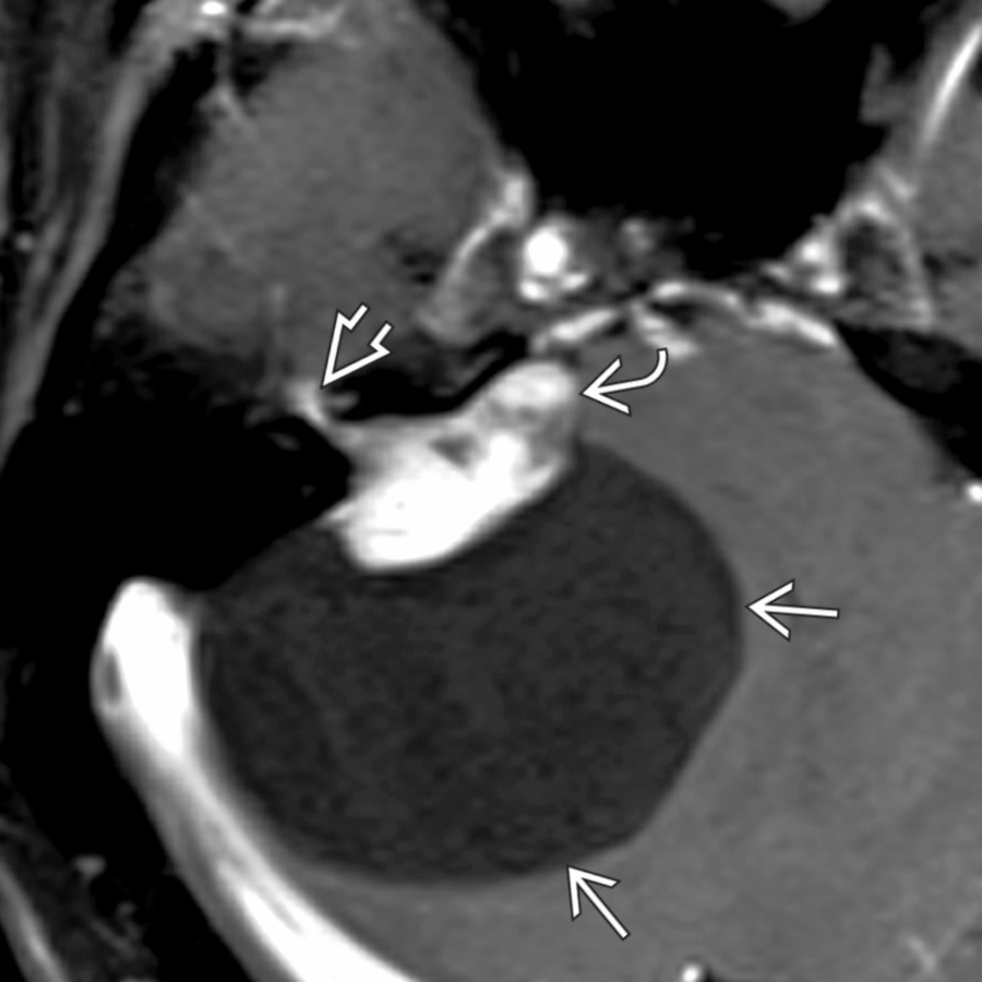 Axial T1WI C+ MR in the same patient shows facial nerve schwannoma  with associated large arachnoid cyst . Notice the labyrinthine facial nerve schwannoma tail .