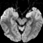 Axial DWI MR shows hyperintense signal consistent with restricted diffusion within both amygdalae.