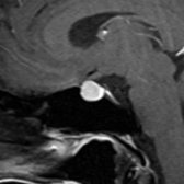 Sagittal T1 C+ MR in a 38-year-old woman undergoing infertility treatment imaged for headache shows a homogeneously enhancing pituitary measuring 12 mm.