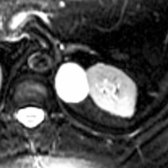 Axial T2 MR shows a high-signal left adrenal cyst .