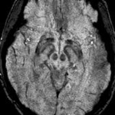 Axial T2* SWI MR reveals normal mineralization of the red nucleus , substantia nigra , & fasciculi nigrae .