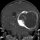 Coronal T1 C+ MR shows a large left hemispheric mass with solid enhancement centrally  and cystic component  peripherally. Pilomyxoid variant of pilocytic astrocytomas may present in younger patients, involve the optic pathway, and are more locally aggressive.