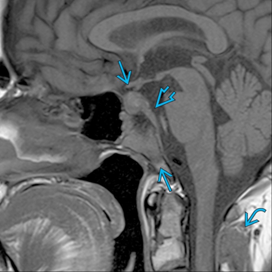 Sagittal T1 MR shows an infiltrative T1-hypointense lesion in the pituitary gland and clivus  with adjacent dural thickening . An additional cervical spine osseous lesion  is present in this case of metastatic prostate cancer.