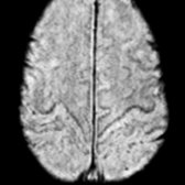 Axial SWI MR in an 83-year-old woman demonstrates linear hypointensity along the cortical motor area  referred to as cortical pencil lining. This relates to natural age-related iron accumulation in healthy brains.