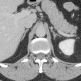 First of 3 axial CECT images shows normal adrenal glands bilaterally. The right adrenal is usually suprarenal, touches the back of the IVC, and lies lateral to the right crus and medial to the liver. The left adrenal usually lies ventral to the upper pole of the left kidney and behind the splenic vein. The left adrenal often appears as an inverted Y shape, while the right is more like an inverted V.
