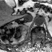 Axial chemical shift (opposed-phase) MR shows a heterogeneous right adrenal mass with signal loss at fat/soft tissue interfaces.